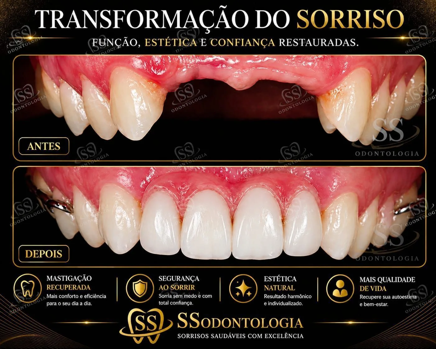 Antes e depois: Prótese Parcial Removível Caracterizada
