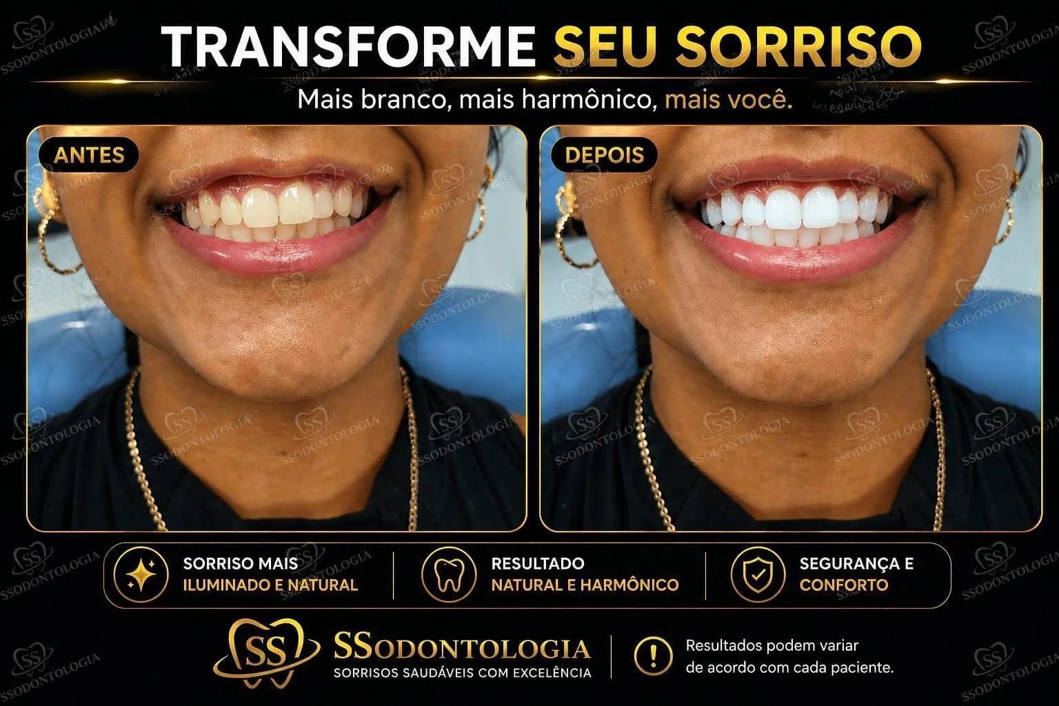 Antes e depois: Clareamento Dental