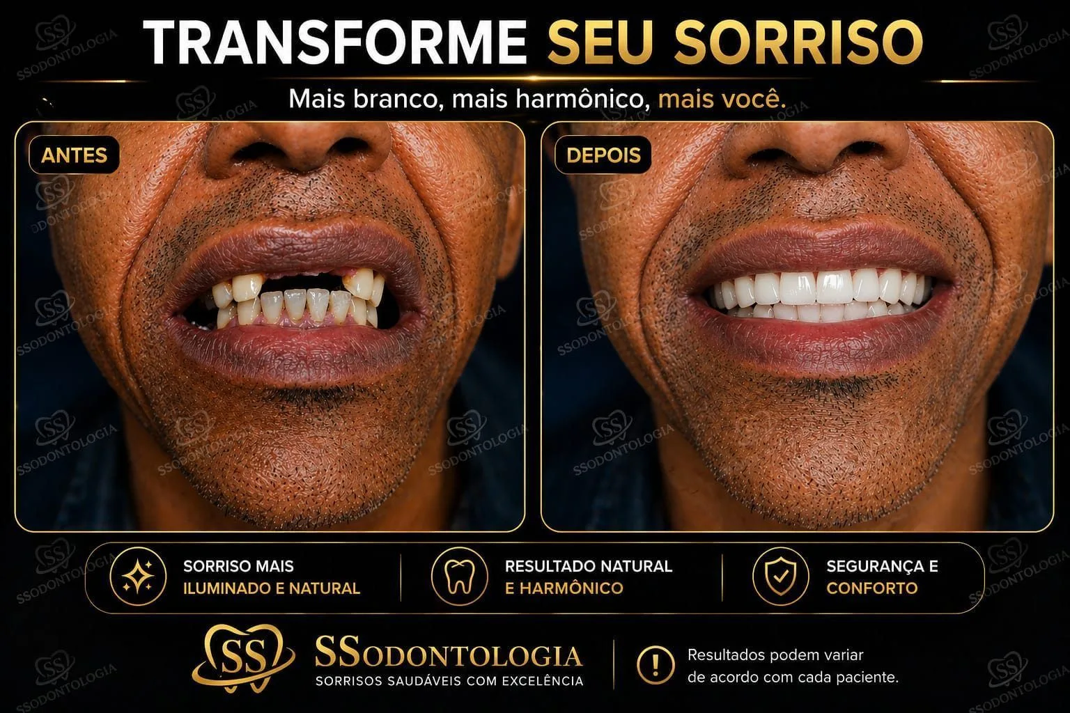 Antes e depois: Implantes e Prótese
